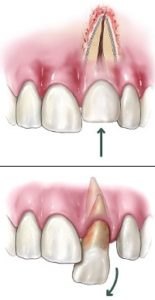 A drawing featuring dental trauma.